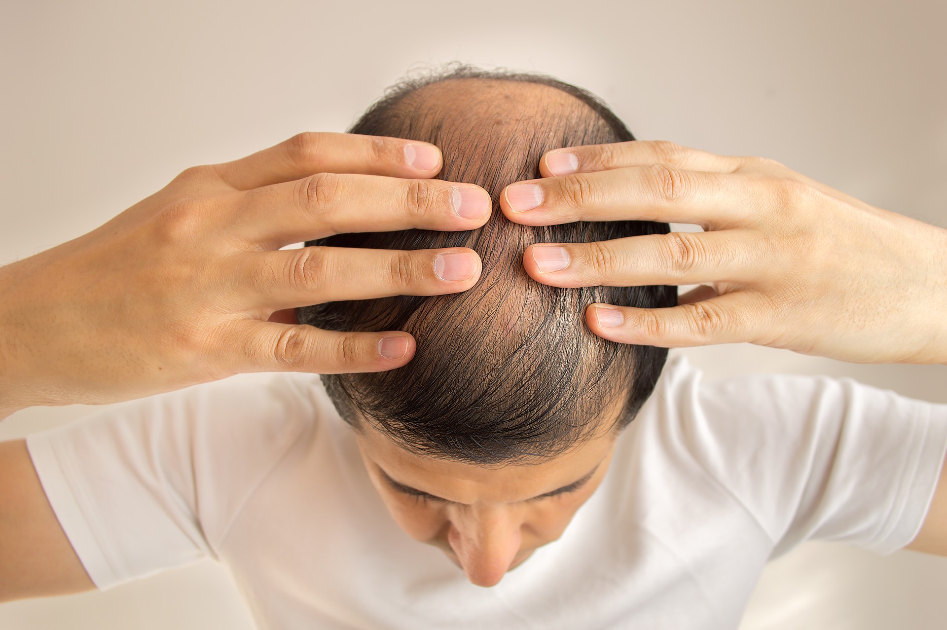 Man with thinning hair inspecting the top of his scalp, displaying signs of hair loss.