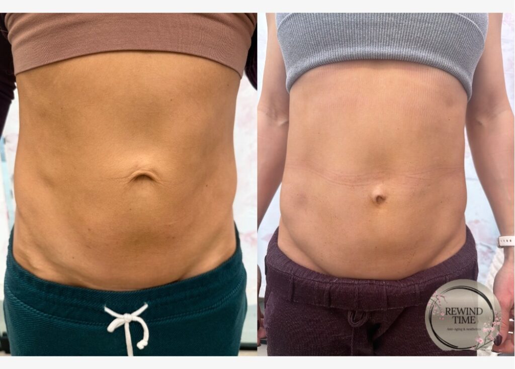 Before and after TriLift body treatment at Rewind Time Anti-Aging & Aesthetics in Lenexa, KS