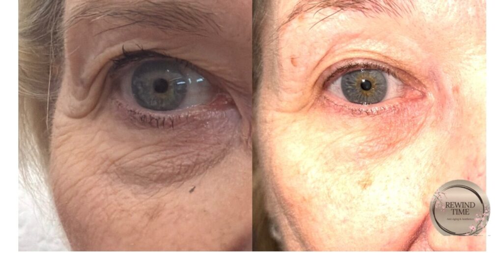 Before and after TriLift eye area treatment at Rewind Time Anti-Aging & Aesthetics in Lenexa, KS