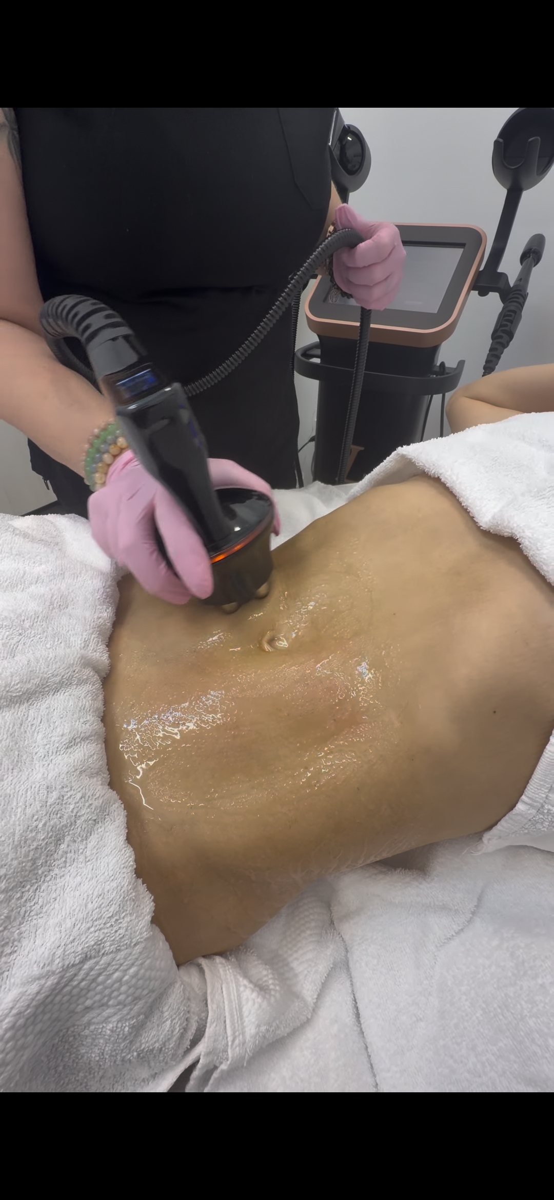 Laura McDonald performing a triLift radiofrequency skin tightening treatment on a client’s abdomen at Rewind Time in Lenexa, KS