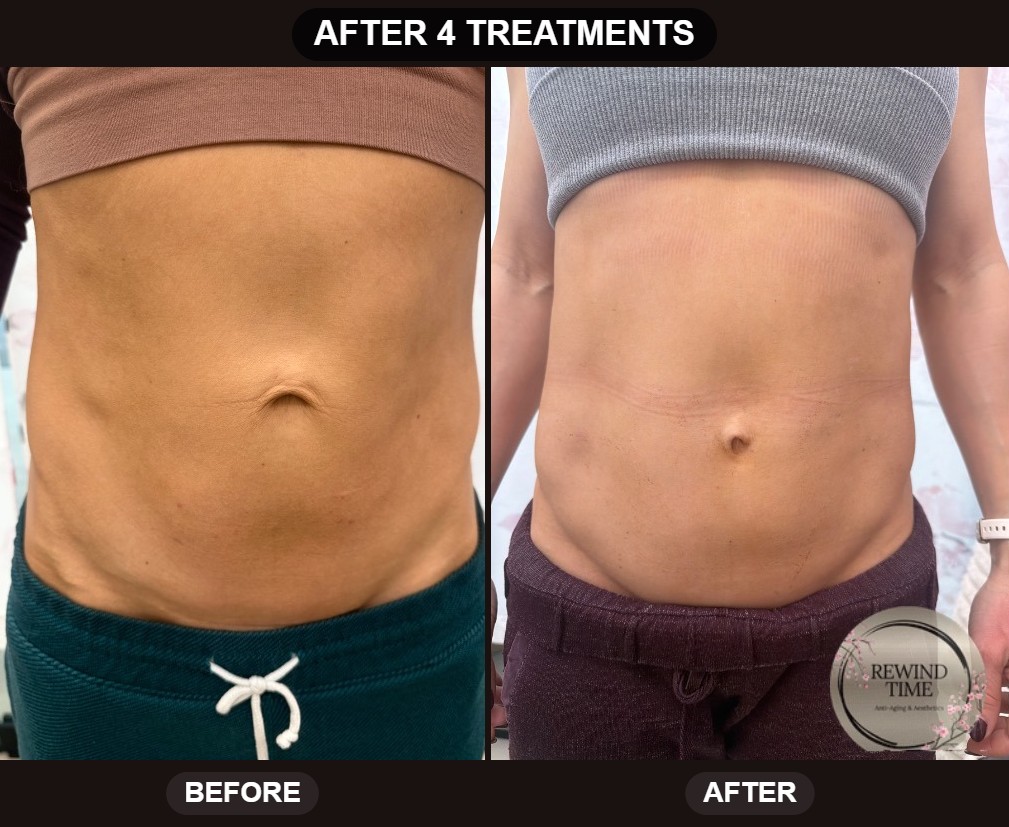 Abdomen before and after four triLift treatments showing a firmer, more defined midsection at Rewind Time in Lenexa, KS