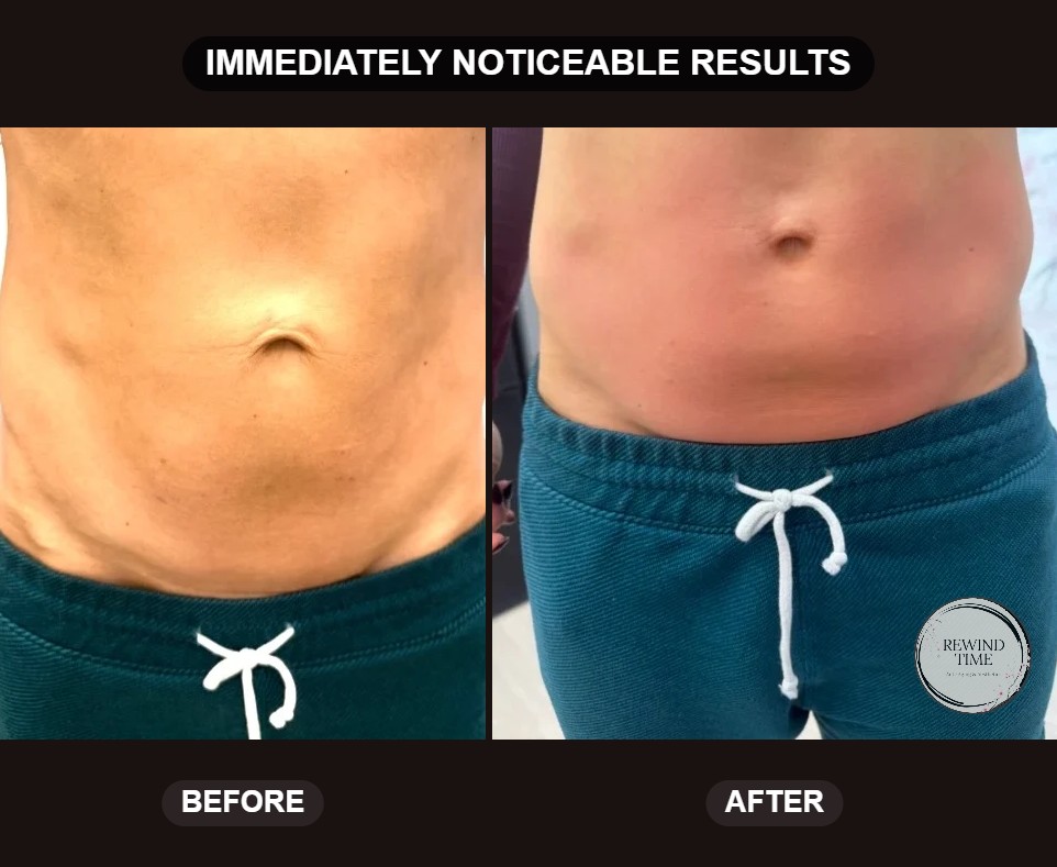 Abdomen before and immediately after a triLift treatment, showing immediately noticeable results, at Rewind Time in Lenexa, KS