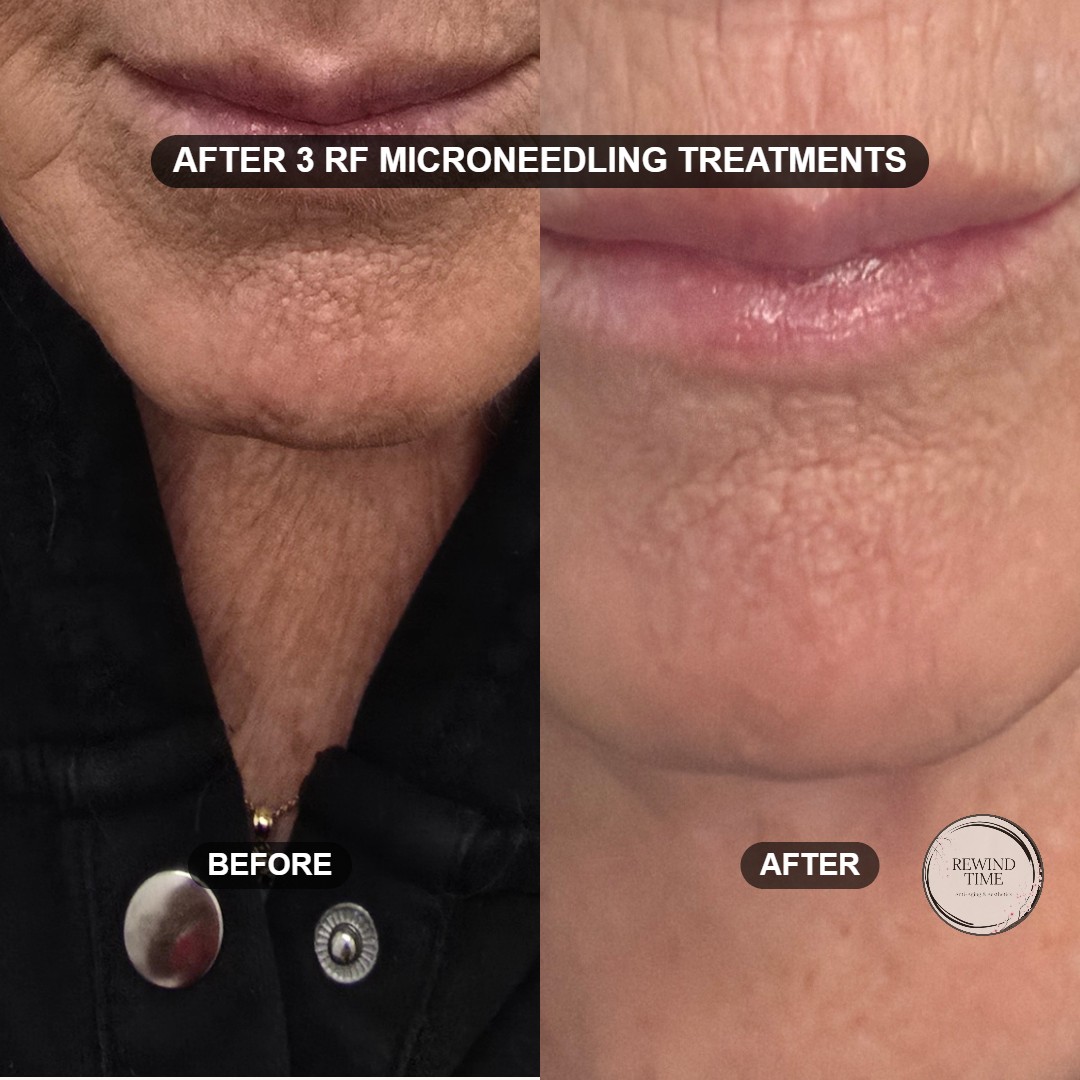 Front of neck and jawline before and after three RF microneedling treatments at Rewind Time in Lenexa, KS