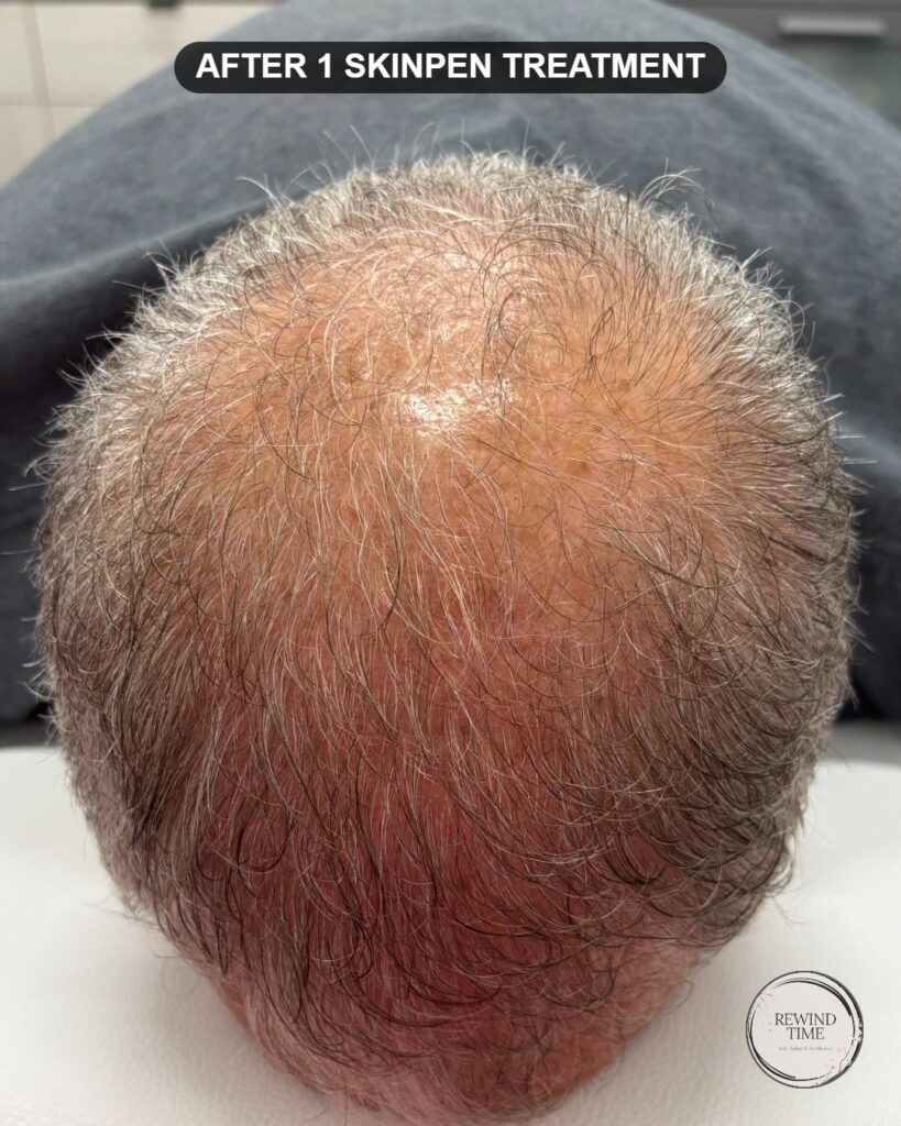 Scalp after one SkinPen microneedling hair restoration treatment at Rewind Time in Lenexa, KS