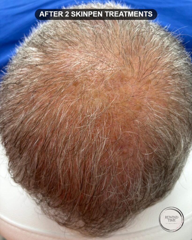 Scalp after two SkinPen microneedling hair restoration treatments showing improved density at Rewind Time in Lenexa, KS