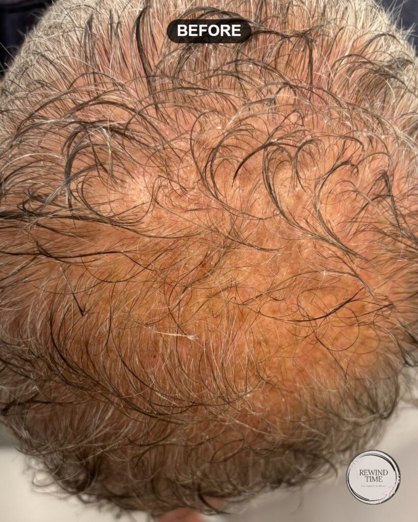 Thinning scalp before SkinPen microneedling hair restoration at Rewind Time in Lenexa, KS