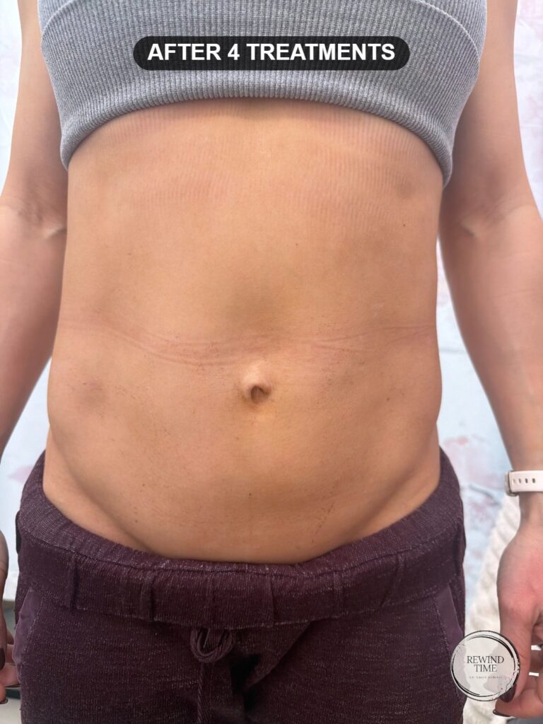 Abdomen after four triLift skin tightening treatments, firmer and more defined, at Rewind Time in Lenexa, KS