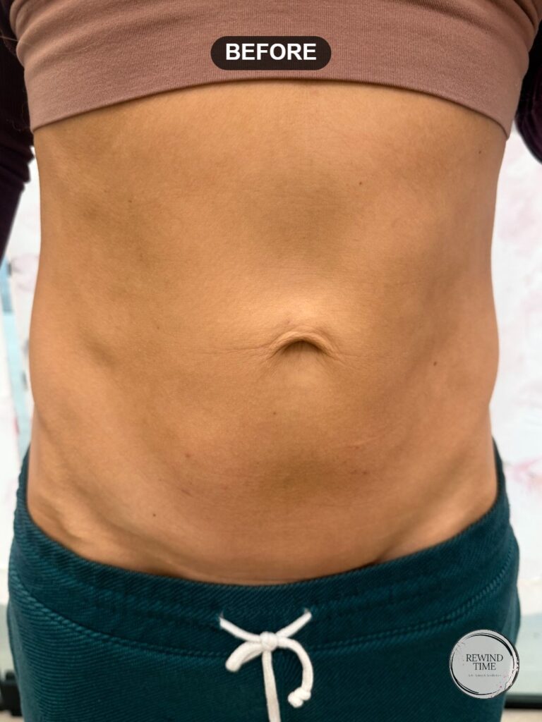 Abdomen before triLift skin tightening at Rewind Time Anti-Aging & Aesthetics in Lenexa, KS