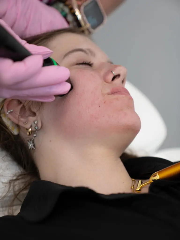 RF microneedling (TriFX) treatment for active acne at Rewind Time Anti-Aging & Aesthetics in Lenexa, KS
