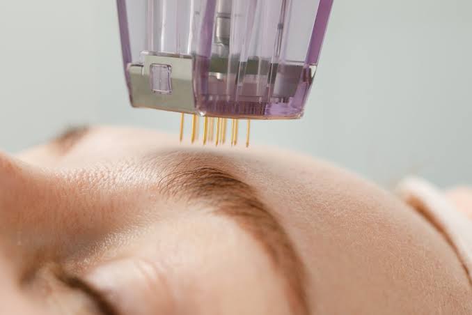 RF microneedling handpiece delivering radiofrequency energy through fine needles into the skin