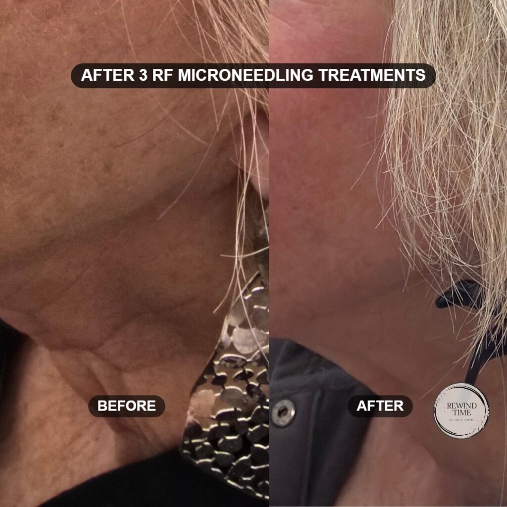Side view of neck before and after three RF microneedling treatments at Rewind Time in Lenexa, KS