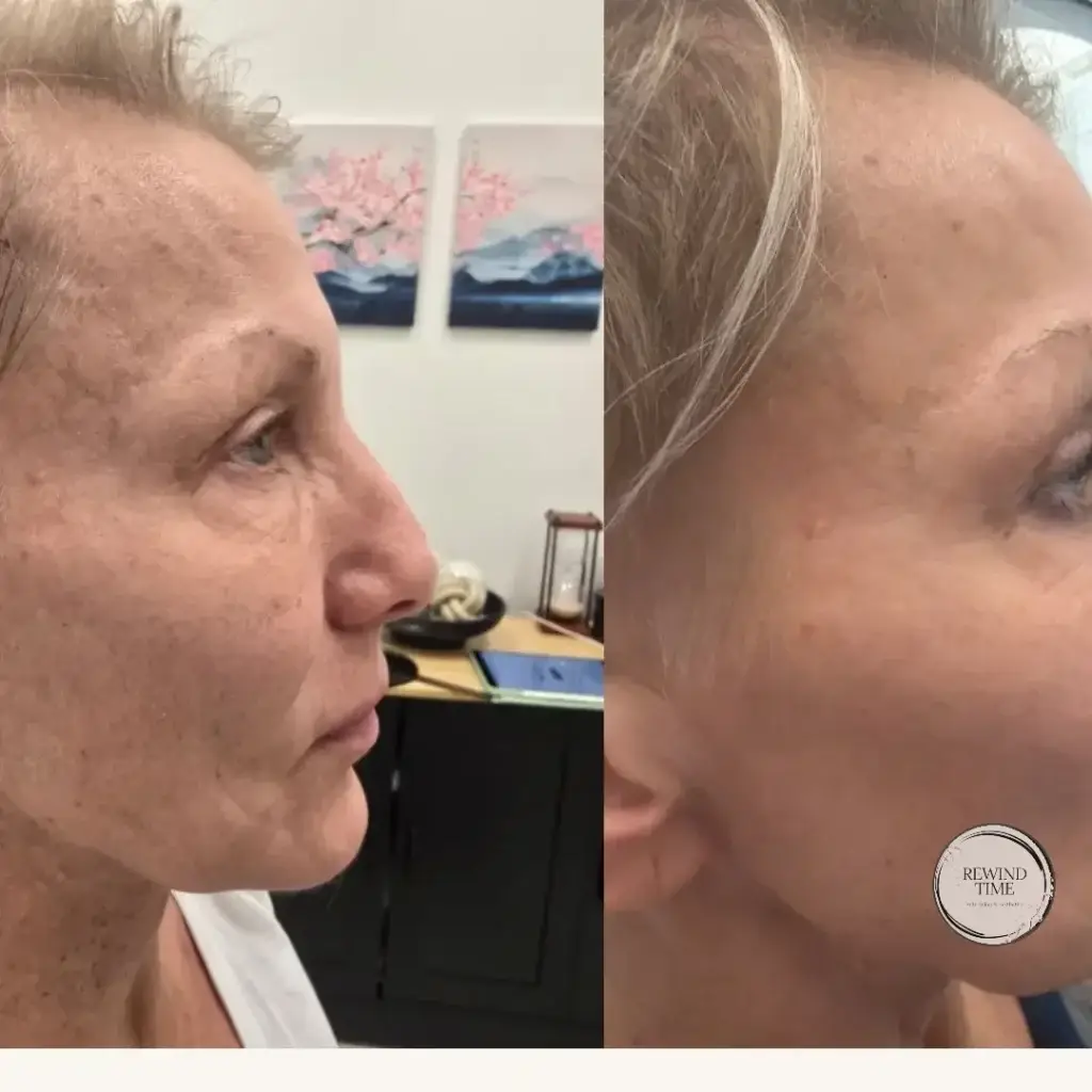 Before and after skin rejuvenation showing smoother, brighter skin at Rewind Time Anti-Aging & Aesthetics in Lenexa, KS