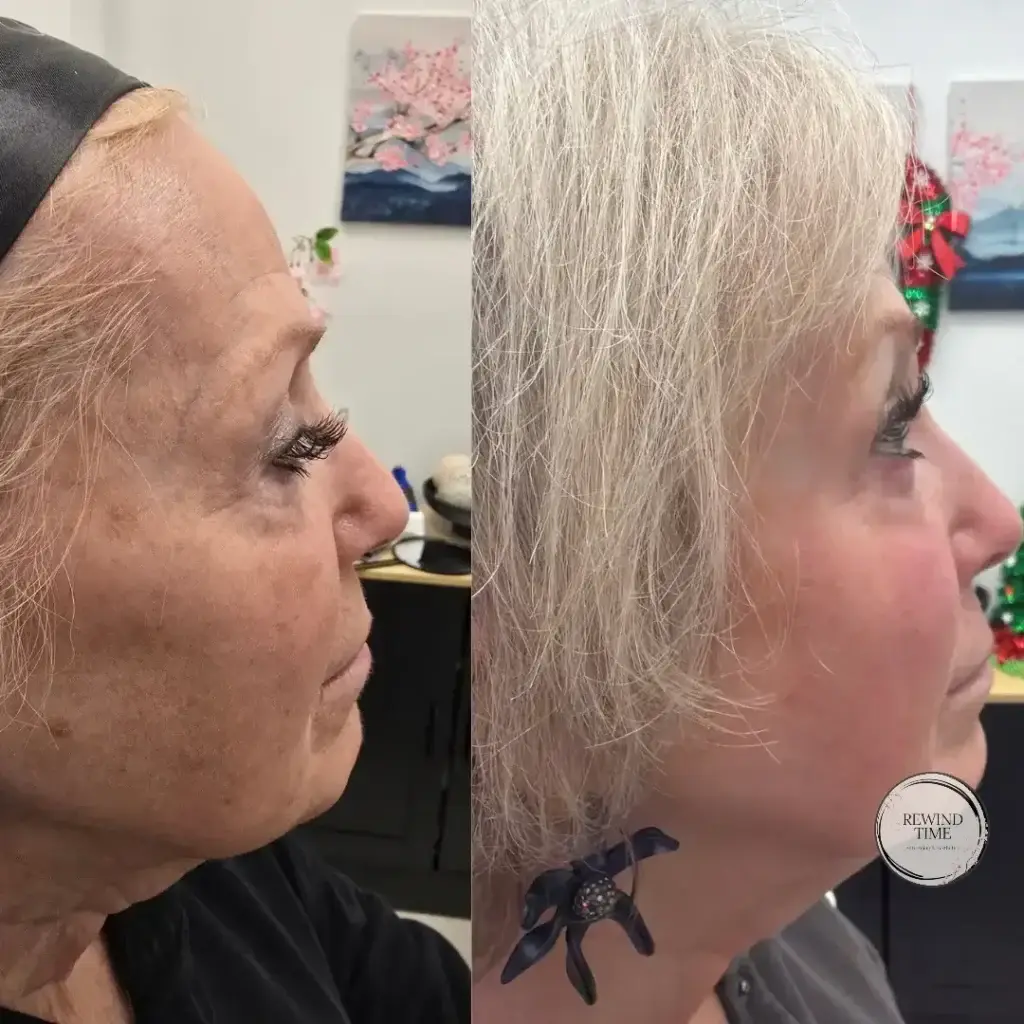 Before and after skin rejuvenation treatment at Rewind Time Anti-Aging & Aesthetics in Lenexa, KS