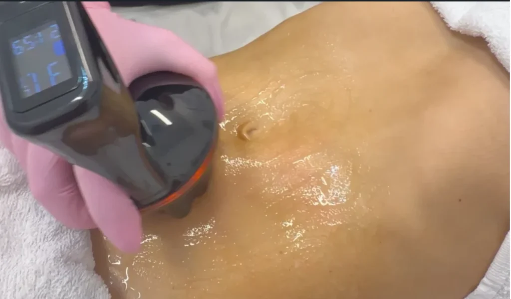 Close-up of the triLift applicator delivering radiofrequency energy to the abdomen during a body treatment in Lenexa, KS