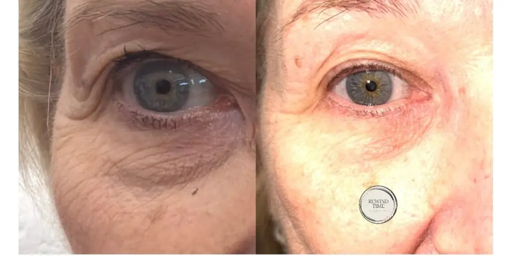 Before and after TriLift eye area treatment at Rewind Time Anti-Aging & Aesthetics in Lenexa, KS