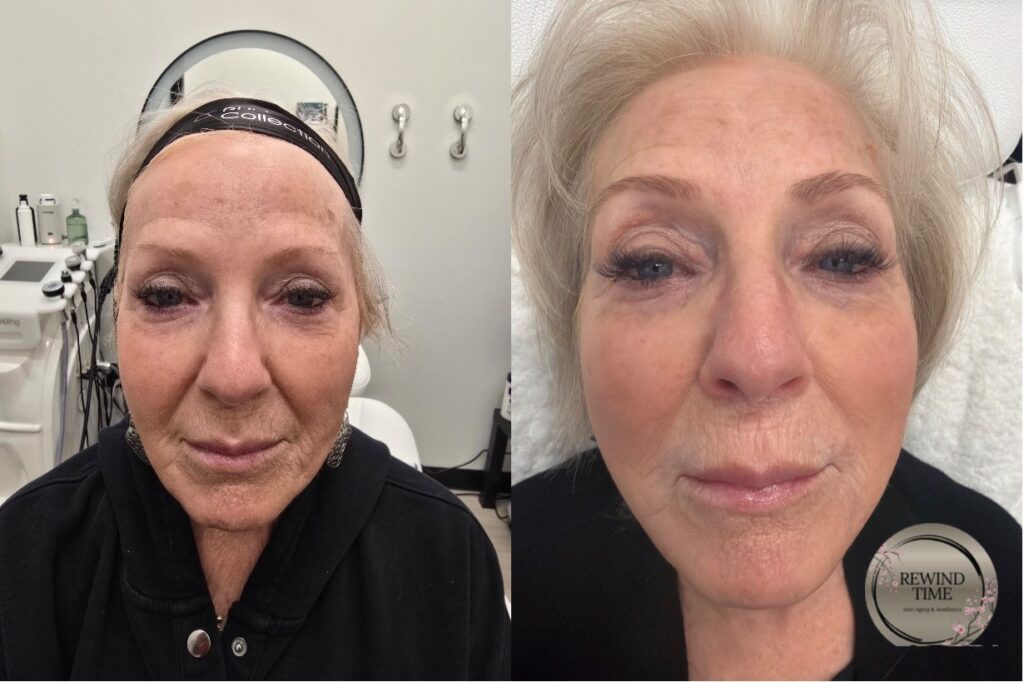 Before and after TriLift face and neck treatment at Rewind Time Anti-Aging & Aesthetics in Lenexa, KS